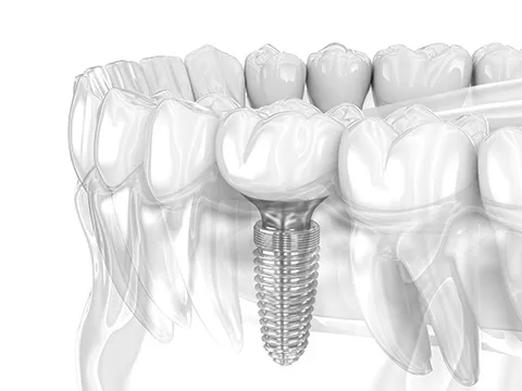 Service Implant